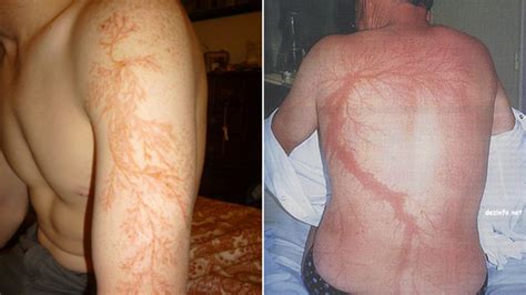 people hit by lightning.